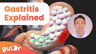 What is Gastritis  The GutDr Explains 3D Gut Animation [upl. by Ennaesor]