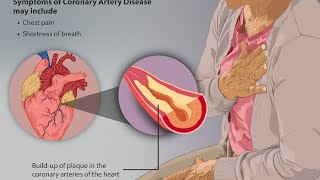 CORONARY ARTERY DISEASE II BSC AND GNM NURSING [upl. by Yllak191]