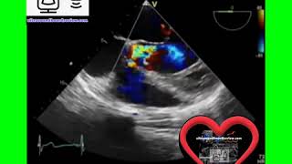 Ultrasound Board Review Bicuspid Aortic Valve Echocardiography Vegetations Aortic Regurgitation [upl. by Templia]