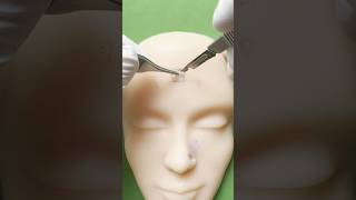 Bilateral advancement flap for forehead reconstruction excision part 2 Link in bio for my pad [upl. by Yenffit520]