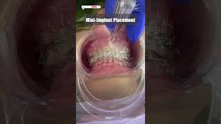 Midline miniscrew  Braces Treatment in India  Latest Technology  dentalbraces smilecorrection [upl. by Uttasta304]