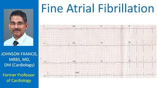 Fine Atrial Fibrillation [upl. by Ardnaxila467]