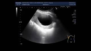 Hydatid Hepatic Cyst [upl. by Ellinad546]