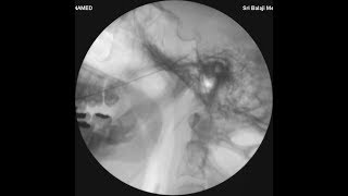 TRIGEMINAL NEURALGIA  RF NERVE ABLATION TREATMENT DR NEERAJ JAIN MD FIMSA CIPSHung FIPPUSA [upl. by Melissa]