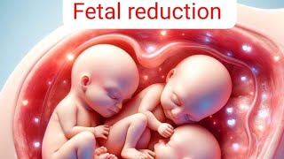 USG guided FETAL REDUCTION [upl. by Sparks]