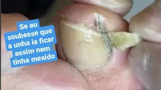 Se Soubesse Que a Unha ia Ficar Assim Nem Tinha Mexido Nails transformation [upl. by Lenroc]