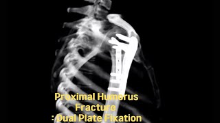 Proximal humerus fracture  Dual plate fixation 근위 상완골 골절 Dual Plate 고정술 [upl. by Dolora]