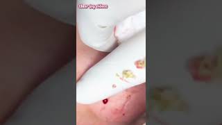 Big Cystic Acne Blackheads ExtractionBlackheads amp Milia Whiteheads Removal Pimple Popping [upl. by Riker]