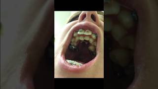 Hyperdontia [upl. by Freya]