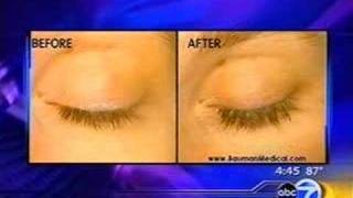 Eyelash Growth Procedures amp Treatments  ABC News Chicago [upl. by Evannia]