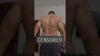 Cupping Therapy Benefits  cupping recovery [upl. by Pravit226]