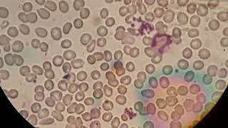 Blood film smear shows normochromic normocytic crenated red cells and aggregation of platelets [upl. by Anitsihc]