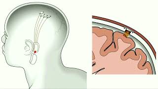 Musks Neuralink says has FDA approval for study of brain implants in humans [upl. by Guilbert345]