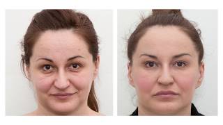 The results of dermal fillers before and after [upl. by Kroo]