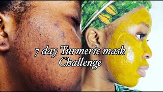 I TRIED TURMERIC MASK FOR 7DAYS  MY HONEST REVIEW  ACNE AND HYPERPIGMENTATION  Just Siphosami [upl. by Taka597]