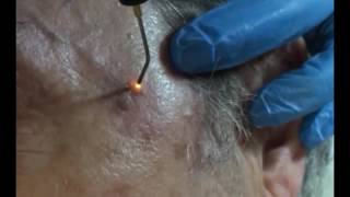 Plasmage  Treatment Fibroma Lentigo [upl. by Thilda121]