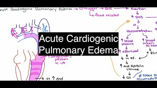 Oedema  Types Causes Symptoms amp Treatment  Part 2  Pathology [upl. by Yllrebmik]