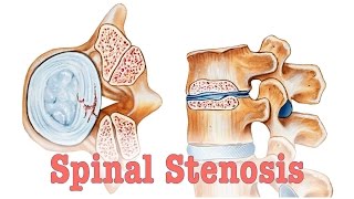 Spinal Stenosis  Surgery vs Chiropractic Care [upl. by Krystyna]