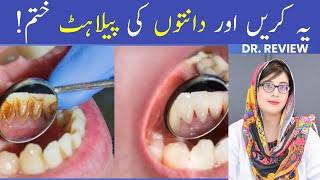 The 1 Top Remedy for Dental Plaque TARTAR [upl. by Nnagrom]