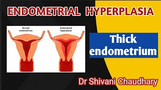 Endometrial hyperplasia  Thick endometrium heavybleeding uterus [upl. by Geller]