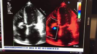 2d echocardiogram Vegetation on ICD pacer wire [upl. by Elyk]