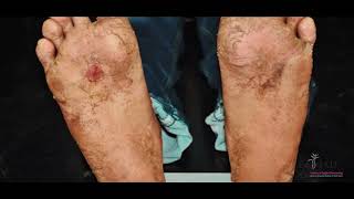 BEEP CARE HINDI  LYMPHATIC FILARIASIS  ELEPHANTIASIS  HAATHI PAAV  INTEGRATIVE TREATMENT  IAD [upl. by Kylah740]