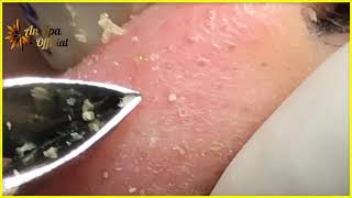 Best Satisfying Nose Plucking Blackheads Whiteheads Removal  Acne Treatment 40 [upl. by Adalheid]