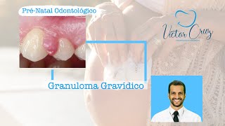 Granuloma gravídico  Pré Natal Odontológico [upl. by Elberta220]