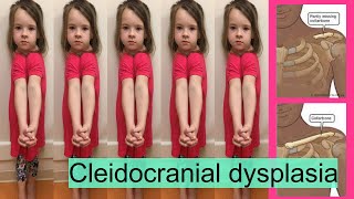 cleidocranial dysplasia [upl. by Ellerehc]