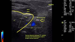 Postural jugular vein obstruction by the atlas vertebra causing intracranial hypertension [upl. by Aitan254]