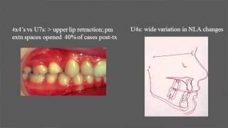 Treatment and stability of Class II Division 2 malocclusion in children and adolescents [upl. by Wincer]