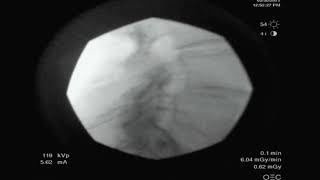 Fluoroscopic lumbar epidural injection lateral contrast spread [upl. by Melan]