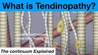 The Tendinopathy Tendon Tendonitis Continuum Theory Explained [upl. by Nellac51]