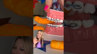 CHIPS YOU CANT EAT WITH BRACES ON 🦷 Orthodontist Reacts w BETTER OPTIONS CRUNCHY FOOD ASMR [upl. by Annehsat]