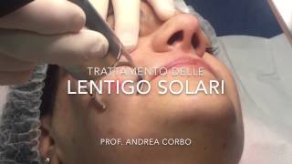 Lentigo Solari  Trattamento con Laser frazionato CO2 [upl. by Kannan373]