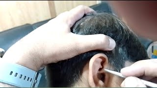 Removing Overflowed Ear wax  ear wax removal asmrearwax satisfying [upl. by Wilde638]