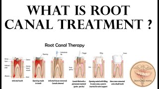 What is Root canal Treatment STEPS IN RCT [upl. by Aires967]