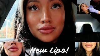 I got lip injections for the 1st time [upl. by Hedvig]