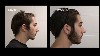 Minoxidil Beard Growth  3 Month Transformation  Timelapse BEFORE and AFTER [upl. by Harriott731]