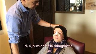 pansement rhinoplastie Tunisie [upl. by Romelle288]