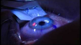 Laser Eye Surgery  The Patient Experience at London Vision Clinic on Harley St London [upl. by Odnam]