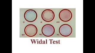 Widal Test  Slide and Tube Full Procedure [upl. by Irisa]