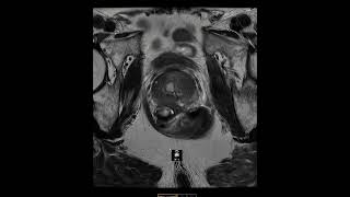 Prostate cancer on MRI with extraprostatic extension [upl. by Bunch]