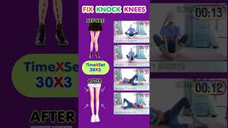 KNOCK KNEES CORRECTION EXERCISE [upl. by Arly]