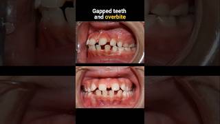 Braces for gapped teeth and overbite braces orthodontist bracesoff dentist [upl. by Maureen]