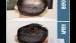 Provillus Hair Loss Before and After Pics [upl. by Entsirhc]