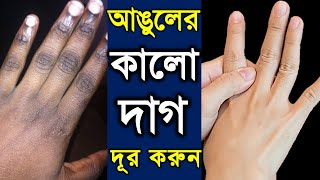 আঙ্গুলের কালো দাগ দূর করুন আঙ্গুলের ভাঁজের গিঁটের কালো দাগ দূর করার খুব সহজ পদ্ধতি [upl. by Rosita477]