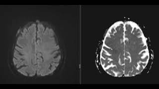 CASE 9 A KNOWN CASE OF bronchogenic carcinoma [upl. by Noeruat]