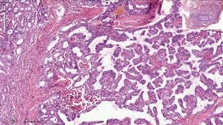 Papillary Thyroid Carcinoma  Histopathology [upl. by Janey999]