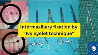 INTERMAXILLARY FIXATION IMF [upl. by Berkly662]